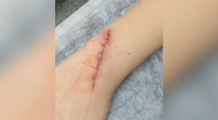 Aluno tem braço cortado com lâmina de navalha durante discussão